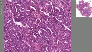 Endometrial Adenocarcinoma  Histopathology [upl. by Mahala428]