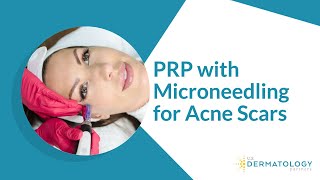 PRP with Microneedling for Acne Scars [upl. by Mello]