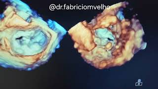 Necrose caseosa no anel mitral Componente móvel em face Ventricular [upl. by Hareemas]