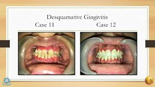 A diagnostic insight of common mucocutaneous lesions II MGMDCH [upl. by Teplica]