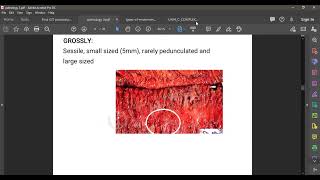 L79 PATHOLOGY NON NEOPLASTIC POLYPS [upl. by Cykana]