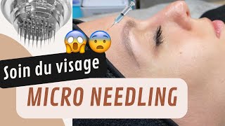 UN SOIN VISAGE AVEC DES AIGUILLES 😨 JE TESTE LE MICRONEEDLING AVIS ET EXPLICATIONS [upl. by Brynne]