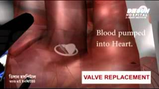 Heart valve replacement in Desun Hospital Kolkata [upl. by Anifesoj]