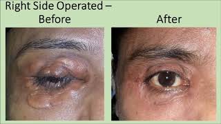 Large Xanthelasma Treatment  Xanthelasma Removal by Dr Ashutosh Shah Elegance Clinic Surat Gujarat [upl. by Ahseinad]