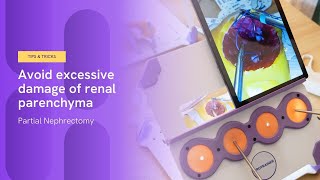 How to avoid excessive damage of renal parenchyma  Partial Nephrectomy [upl. by Hadihsar]