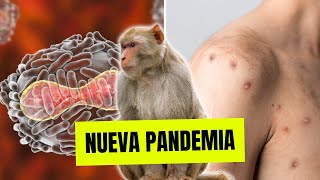 TODO lo que DEBES SABER de la VIRUELA DE MONO  ¿Nueva Pandemia [upl. by Braunstein]