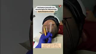 Mesoterapia Capilar Mesoterapia con Dutasteride para alopecia mesoterapia hair cabello salud [upl. by Gunthar467]