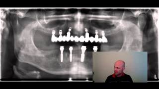 Oberkiefer Implantate auch ohne Knochenaufbau möglich [upl. by Kirimia903]