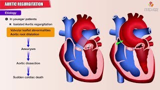 Aortic regurgitation  Aortic insufficiency  Etiology  Pathology  Diagnosis and Treatment USMLE [upl. by Saul879]