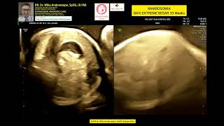 Makrosomia bayi extreme besar 33 weeks [upl. by Dotti]