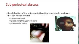 Complications of Otitis media and mastoiditis [upl. by Ahseenal]