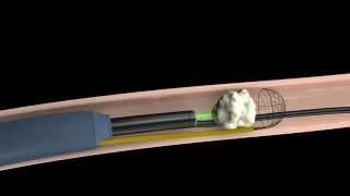 Calculo Renal Tratamiento mediante fragmentacion interna Urologia Peruana [upl. by Ayrolg]