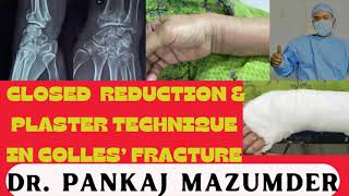 Colles’ fracture closed reduction distal radius ot youtube viral trending video boneartist [upl. by Oiramaj]