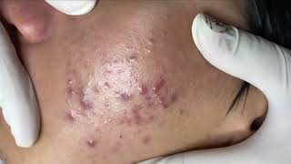 Blackheads amp Whiteheads Removal New 2024 Acne Treatment With Nhat Bang [upl. by Rodmann]