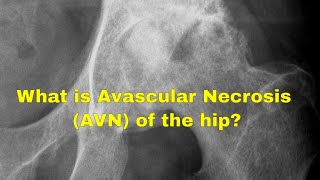 What causes avascular necrosis of the hip AVN [upl. by Butterfield569]