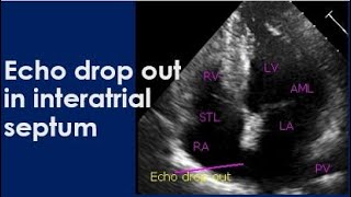 Echo drop out in interatrial septum [upl. by Oinimreh]