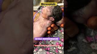 Cervical Myelomeningocele microcephaly vitaminb9 neuraltubedefects drsreedhargandikota [upl. by Ecyrb]