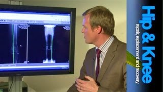 Osteotomy of the Knee The Procedure [upl. by Carney]