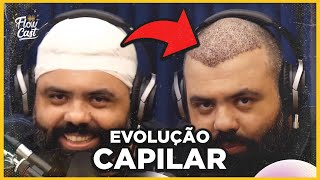 TRANSPLATE CAPILAR ANTES E DEPOIS  FLOW PODCAST FLOW CAST [upl. by Eloc]