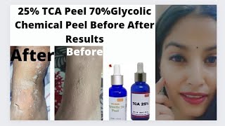 25 TCA peel 70 Glycolic peel Before After Results HandLegsBody Chemical peelIn Hindi [upl. by Noside134]