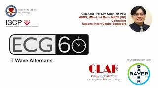 ECG in 60s  T Wave Alternans [upl. by Notsud674]