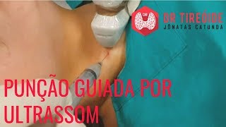 Punção guiada por ultrassom a PAAF  Entenda como é feito essa biópsia [upl. by Navonod86]