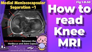 Fig 1B50 Medial Meniscocapsular Separation [upl. by Mure]