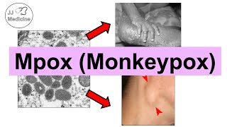 Mpox Monkeypox  Transmission Pathophysiology Signs amp Symptoms Diagnosis Treatment [upl. by Bachman]