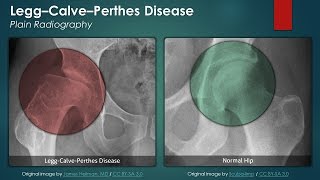 LeggCalvePerthes Disease Plain Radiography [upl. by Erme440]