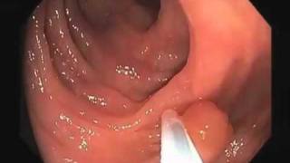 Colonoscopy Video Tour Removal of a Colon Polyp Polypectomy [upl. by Yesima143]