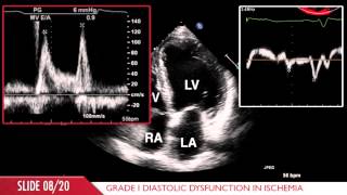 Acute Myocardial Infarction [upl. by Ibbison]