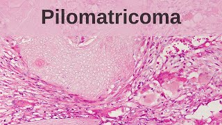 Pilomatricoma Calcifying Epithelioma of Malherbe  Pathology mini tutorial [upl. by Neyuq]