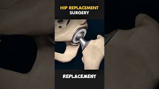 Hip replacement surgery medicalsurgical medicalstudent physiotherapy medical medicalanimation [upl. by Hnamik617]