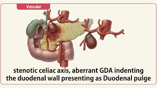 Stenotic celiac axis aberrant GDA indenting the duodenal wall presenting as Duodenal pulge [upl. by Eon]