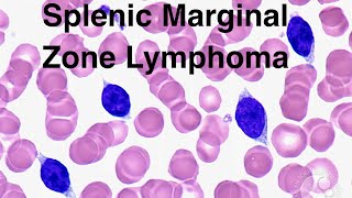 Splenic marginal zone lymphoma [upl. by Adlee]