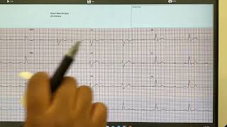 Analyzing an AtrioVentricular AV Heart Block and an Irregularly irregular Rhythm [upl. by Zednanref]