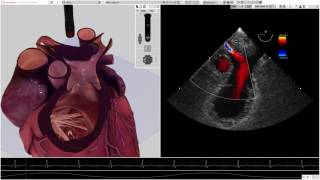 HeartWorks Pulmonary Embolism [upl. by Zinah]