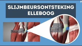 Slijmbeursontsteking elleboog Ontdek de oplossing [upl. by Seem342]