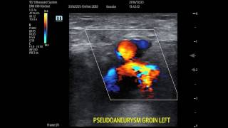 Pseudoaneurysm Sonography Common femoral artery pseudoaneurysm compression and closure [upl. by Marcoux]