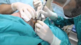 Ablatie cu laser CO2 tumoreta scalp Dr Jianu ProEstetica [upl. by Lynnette]