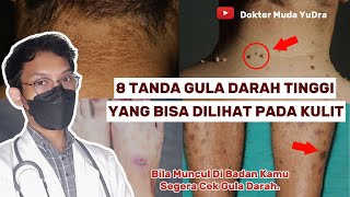 8 Tanda Kulit Kamu Mengalami Gula Darah Tinggi  DIABETES dokyudra [upl. by Carney]