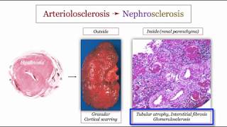 12DaysinMarch Blood Pressure IV Hypertensive Nephrosclerosis for the USMLE Step One Exam [upl. by Thunell]