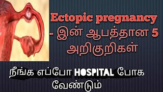 ectopic pregnancy symptoms in tamil  pregnancy symptoms in tamil  Puguntha veedu [upl. by Annaohj]