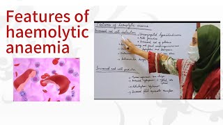 Features of haemolytic anaemia [upl. by Netsrak]