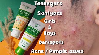 Facewash for acne  Acnes facewash review  pimple solution face wash Acne treatment [upl. by Cornell]