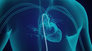 Coronary Angioplasty Procedure  Stent Implantation [upl. by Noirret]