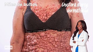 El caso más extremo de neurofibromatosis  Doctora Mercy dermatóloga [upl. by Khalil]