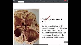 Pathology CNS cerebral edema HERNIATION amp HYDROCEPHALUS L1 part 2 [upl. by Attiuqehs36]