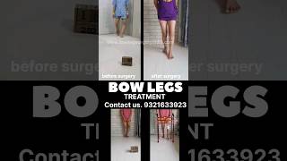 Bow legs CORRECTION in 2 month Complete recovery [upl. by Ruenhs]