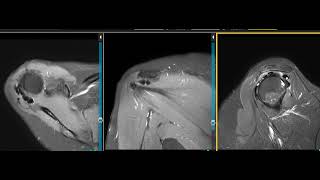 Calcific tendinitis of shoulder [upl. by Amin]